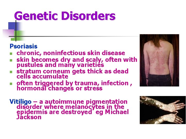 Genetic Disorders Psoriasis n chronic, noninfectious skin disease n skin becomes dry and scaly,