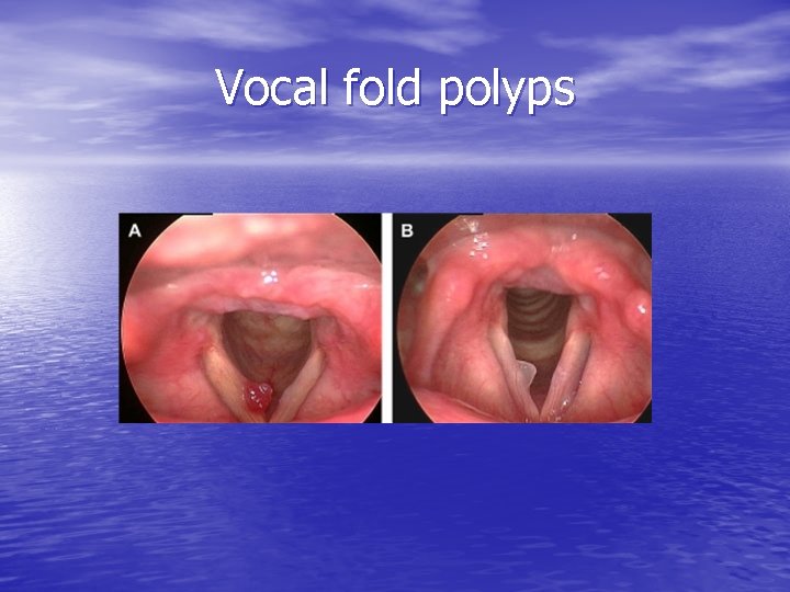 Vocal fold polyps 