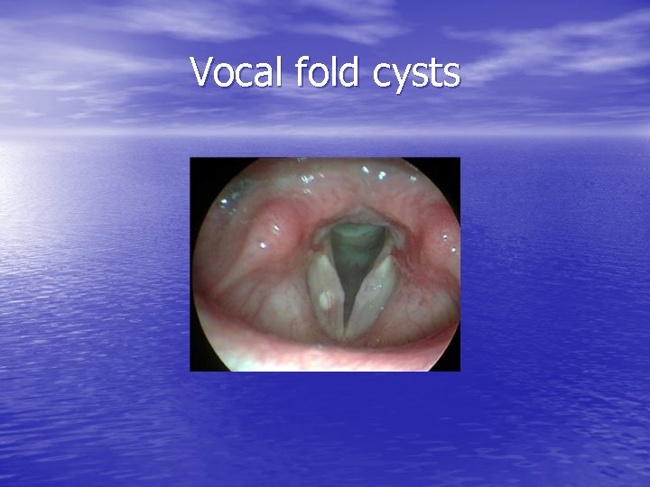 Vocal fold cysts 