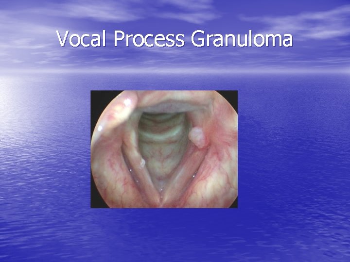 Vocal Process Granuloma 