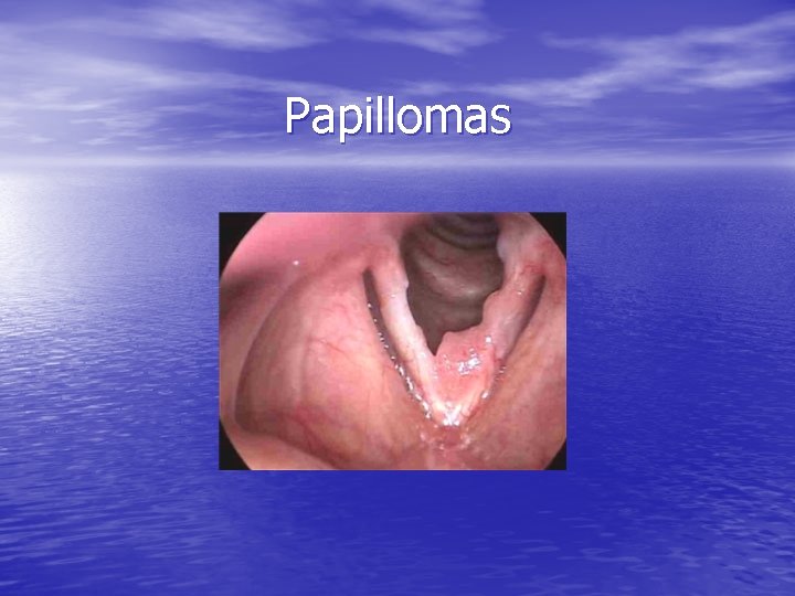 Papillomas 