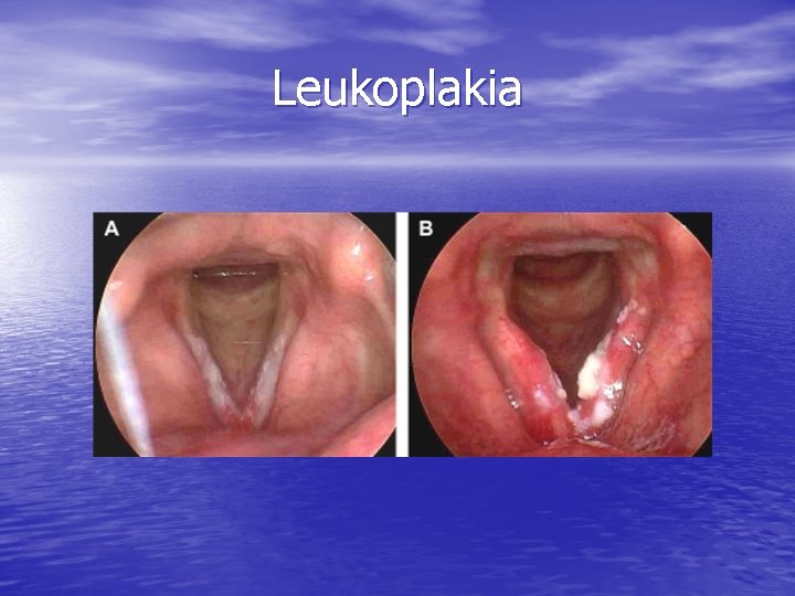 Leukoplakia 