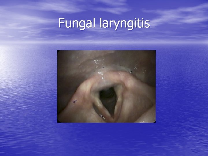 Fungal laryngitis 