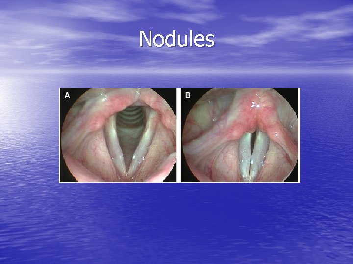 Nodules 