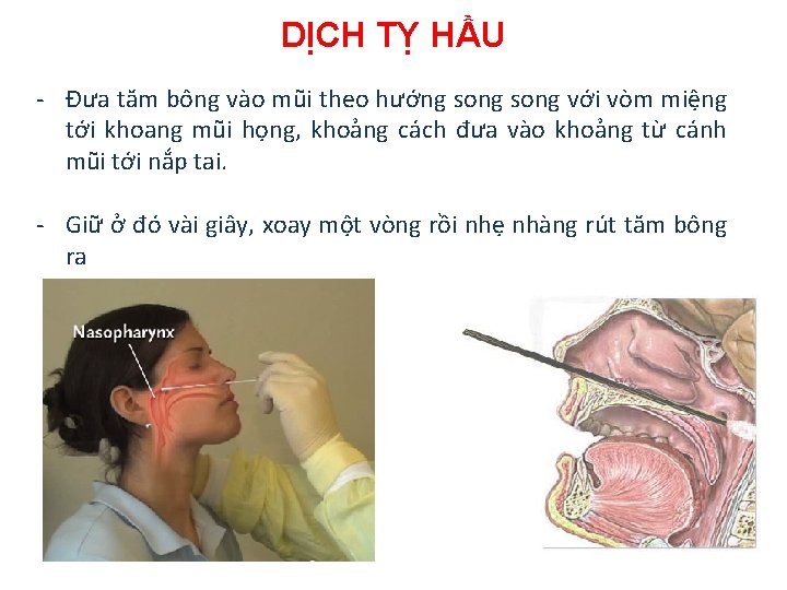 DỊCH TỴ HẦU - Đưa tăm bông vào mũi theo hướng song với vòm