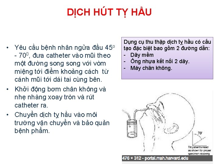 DỊCH HÚT TỴ HẦU • Yêu cầu bệnh nhân ngửa đầu 45 o -