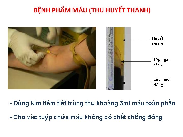 BỆNH PHẨM MÁU (THU HUYẾT THANH) Huyết thanh Lớp ngăn cách Cục máu đông