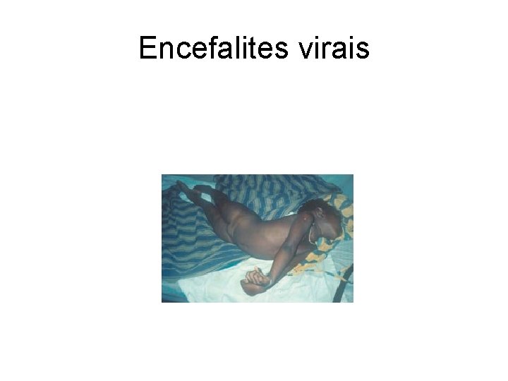 Encefalites virais 