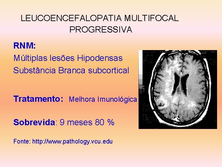 LEUCOENCEFALOPATIA MULTIFOCAL PROGRESSIVA RNM: Múltiplas lesões Hipodensas Substância Branca subcortical Tratamento: Melhora Imunológica Sobrevida:
