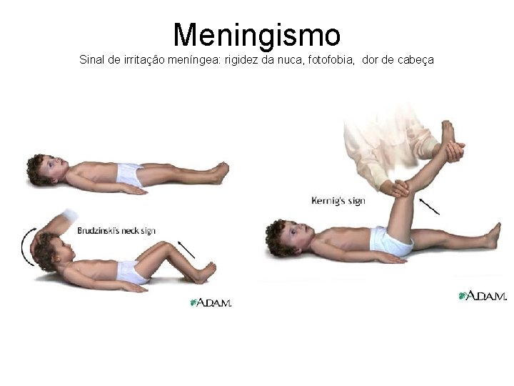 Meningismo Sinal de irritação meníngea: rigidez da nuca, fotofobia, dor de cabeça 
