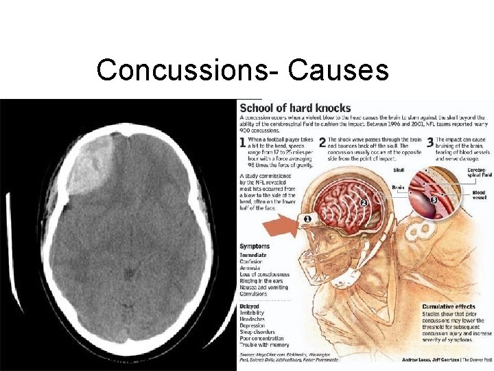 Concussions- Causes http: //www. rosenkilde. com/Concussions. html 