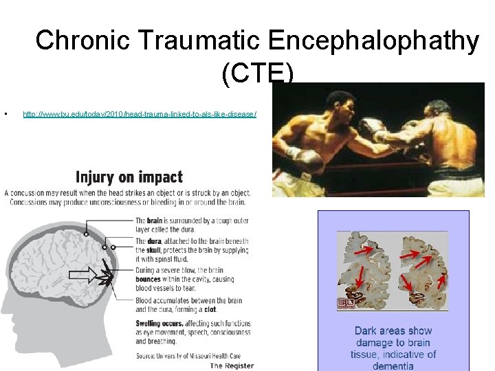 Chronic Traumatic Encephalophathy (CTE) • http: //www. bu. edu/today/2010/head-trauma-linked-to-als-like-disease/ 