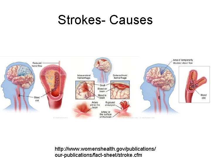 Strokes- Causes http: //www. womenshealth. gov/publications/ our-publications/fact-sheet/stroke. cfm 