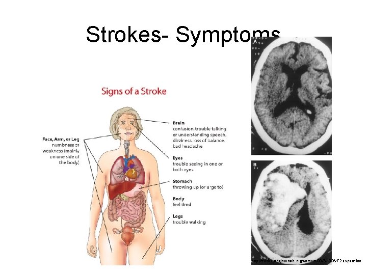 Strokes- Symptoms http: //stroke. ahajournals. org/content/30/7/1326/F 2. expansion 
