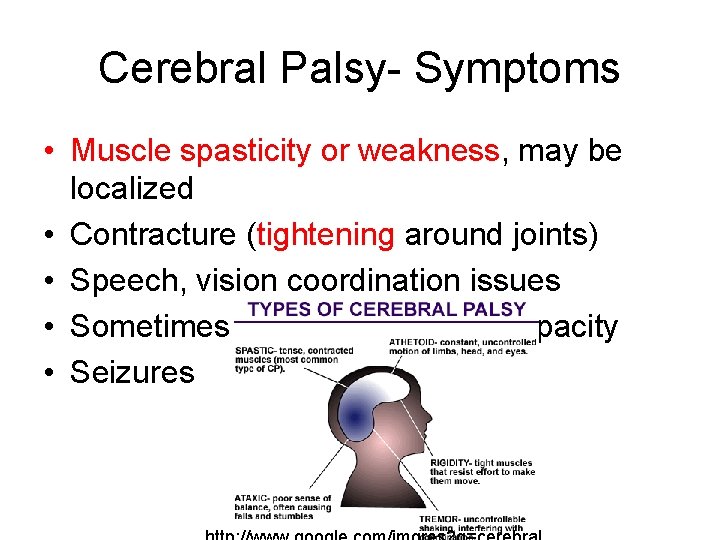 Cerebral Palsy- Symptoms • Muscle spasticity or weakness, may be localized • Contracture (tightening