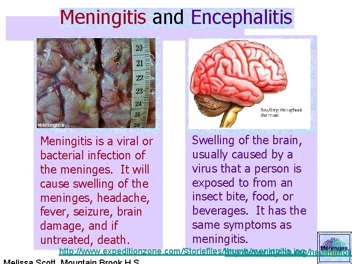 Meningitis and Encephalitis Meningitis is a viral or bacterial infection of the meninges. It