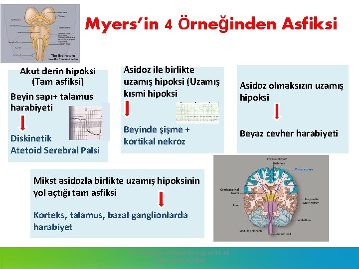 Myers’in 4 Örneğinden Asfiksi Akut derin hipoksi (Tam asfiksi) Beyin sapı+ talamus harabiyeti Diskinetik