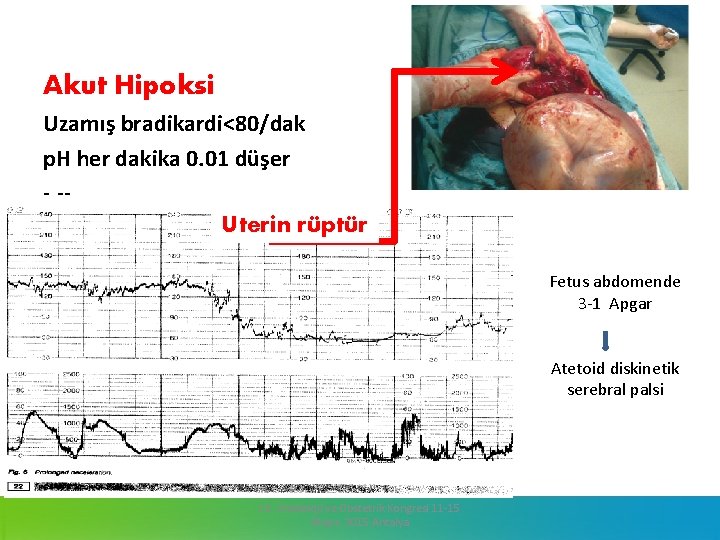 Akut Hipoksi Uzamış bradikardi<80/dak p. H her dakika 0. 01 düşer - -Uterin rüptür