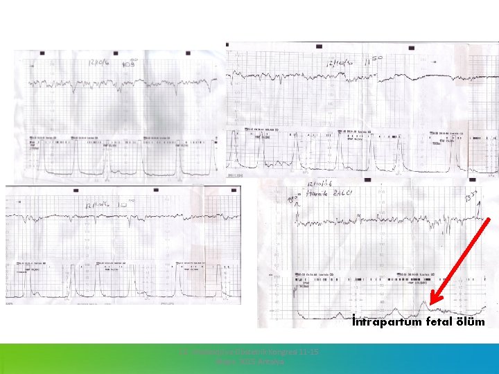 İntrapartum fetal ölüm 13. Jinekoloji ve Obstetrik Kongresi 11 -15 Mayıs 2015 Antalya 