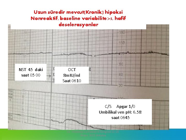 Uzun süredir mevcut(Kronik) hipoksi Nonreaktif, baseline variabilite>5, hafif deselerasyonlar NST 45 daki saat 05