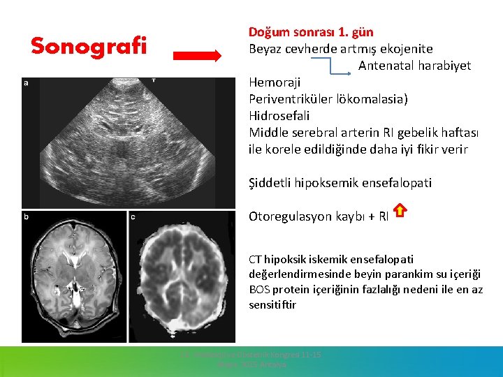 Sonografi Doğum sonrası 1. gün Beyaz cevherde artmış ekojenite Antenatal harabiyet Hemoraji Periventriküler lökomalasia)