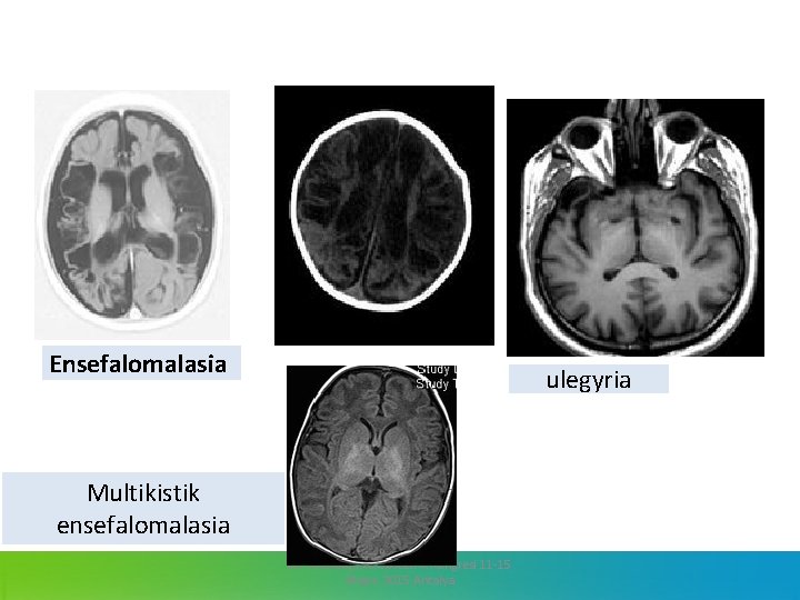 Ensefalomalasia ulegyria Multikistik ensefalomalasia 13. Jinekoloji ve Obstetrik Kongresi 11 -15 Mayıs 2015 Antalya
