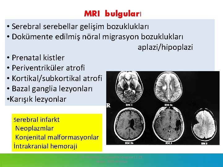 MRI bulguları • Serebral serebellar gelişim bozuklukları • Dokümente edilmiş nöral migrasyon bozuklukları aplazi/hipoplazi.