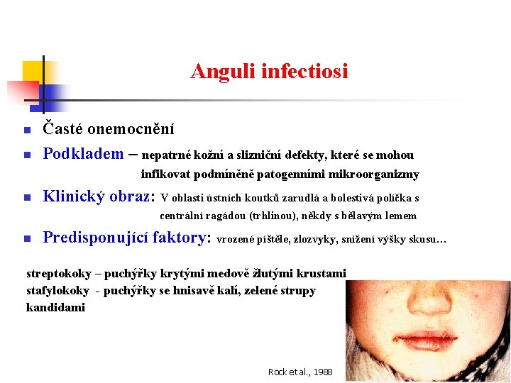 Anguli infectiosi n n Časté onemocnění Podkladem – nepatrné kožní a slizniční defekty, které