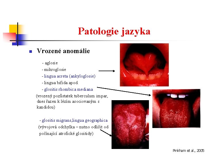 Patologie jazyka n Vrozené anomálie - aglosie - mikroglosie - lingua acreta (ankyloglosie) -