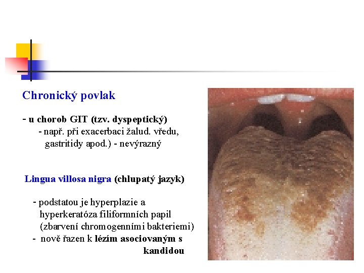 Chronický povlak - u chorob GIT (tzv. dyspeptický) - např. při exacerbaci žalud. vředu,