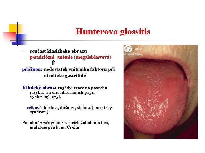 Hunterova glossitis součást klasického obrazu perniciózní anémie (megaloblastová) příčinou: nedostatek vnitřního faktoru při atrofické