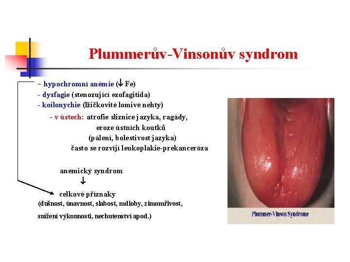 Plummerův-Vinsonův syndrom - hypochromní anémie ( Fe) - dysfagie (stenozující ezofagitida) - koilonychie (lžičkovité
