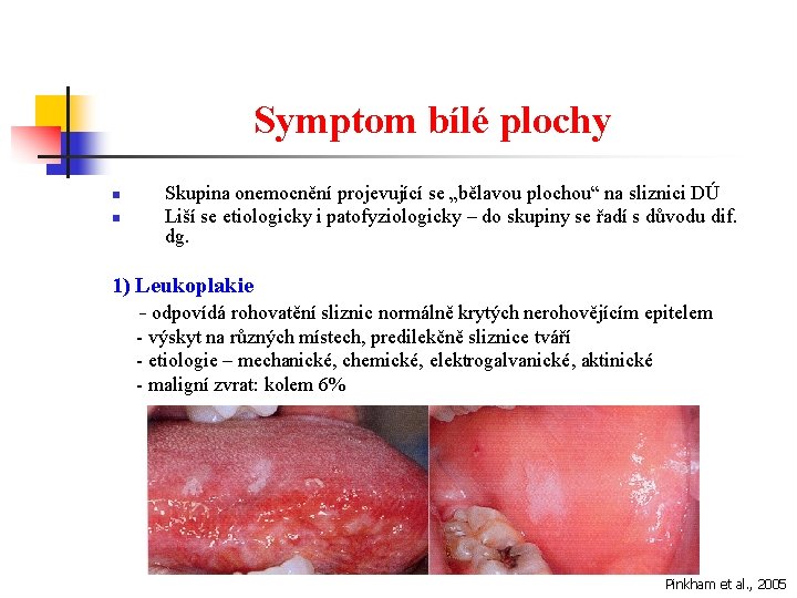 Symptom bílé plochy n n Skupina onemocnění projevující se „bělavou plochou“ na sliznici DÚ