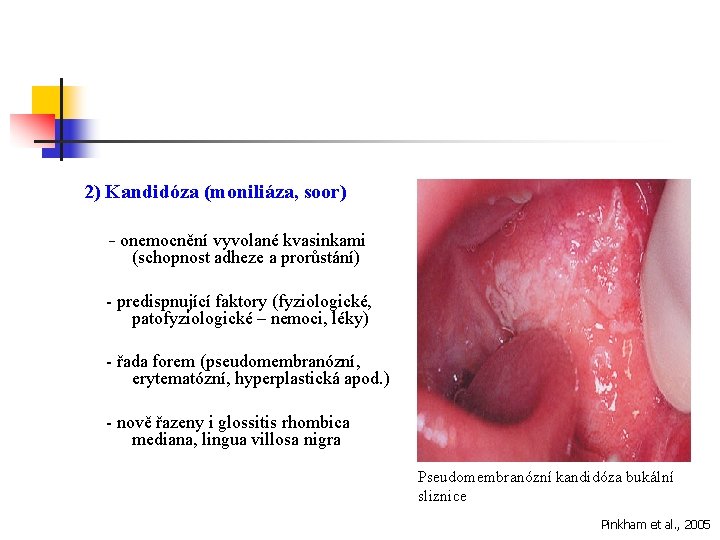 2) Kandidóza (moniliáza, soor) - onemocnění vyvolané kvasinkami (schopnost adheze a prorůstání) - predispnující