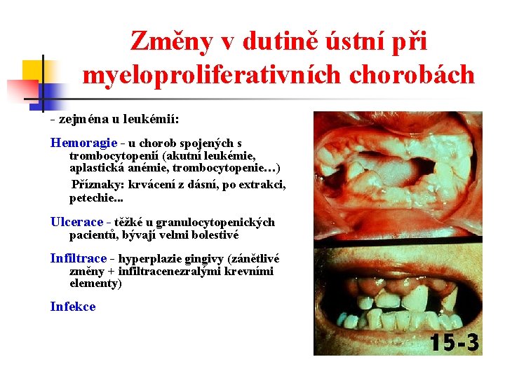 Změny v dutině ústní při myeloproliferativních chorobách - zejména u leukémií: Hemoragie - u