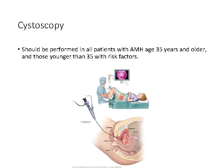 Cystoscopy • Should be performed in all patients with AMH age 35 years and