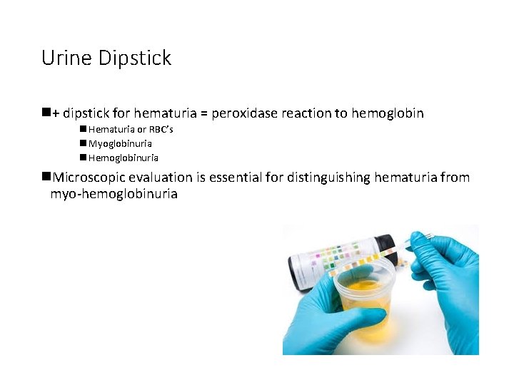 Urine Dipstick n+ dipstick for hematuria = peroxidase reaction to hemoglobin n Hematuria or