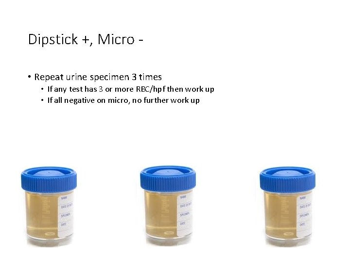 Dipstick +, Micro • Repeat urine specimen 3 times • If any test has