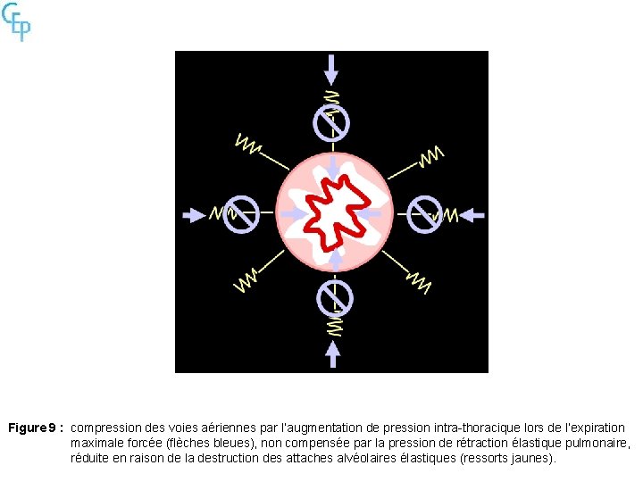 Figure 9 : compression des voies aériennes par l’augmentation de pression intra-thoracique lors de