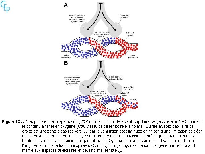 Figure 12 : A) rapport ventilation/perfusion (V/Q) normal ; B) l’unité alvéolocapillaire de gauche