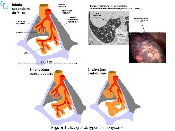 Figure 1 : les grands types d’emphysème 