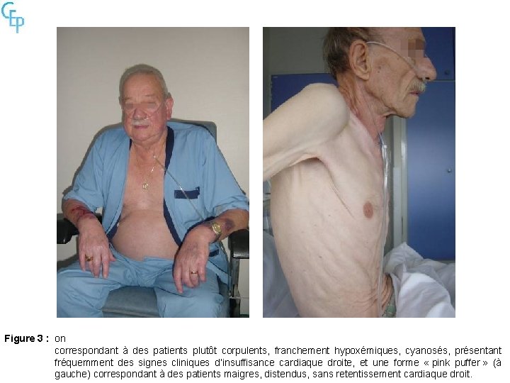 Figure 3 : on correspondant à des patients plutôt corpulents, franchement hypoxémiques, cyanosés, présentant