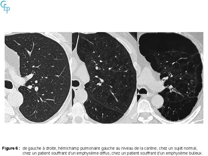 Figure 6 : de gauche à droite, hémichamp pulmonaire gauche au niveau de la