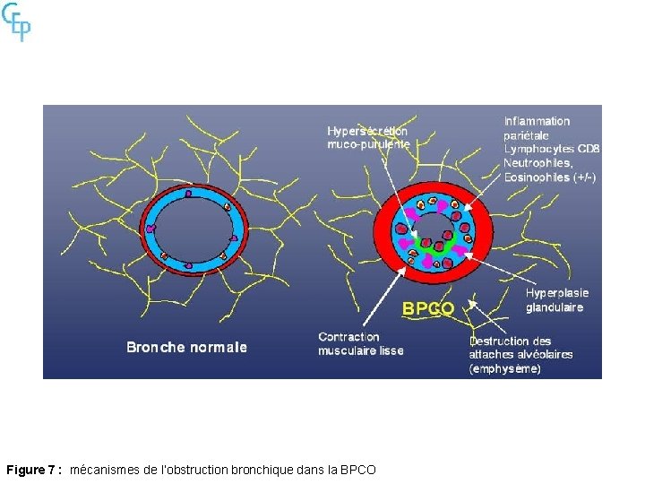 Figure 7 : mécanismes de l’obstruction bronchique dans la BPCO 