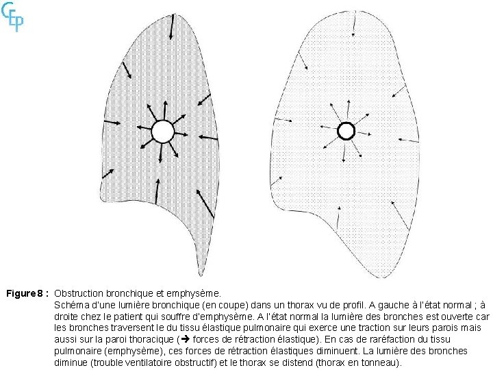 Figure 8 : Obstruction bronchique et emphysème. Schéma d’une lumière bronchique (en coupe) dans