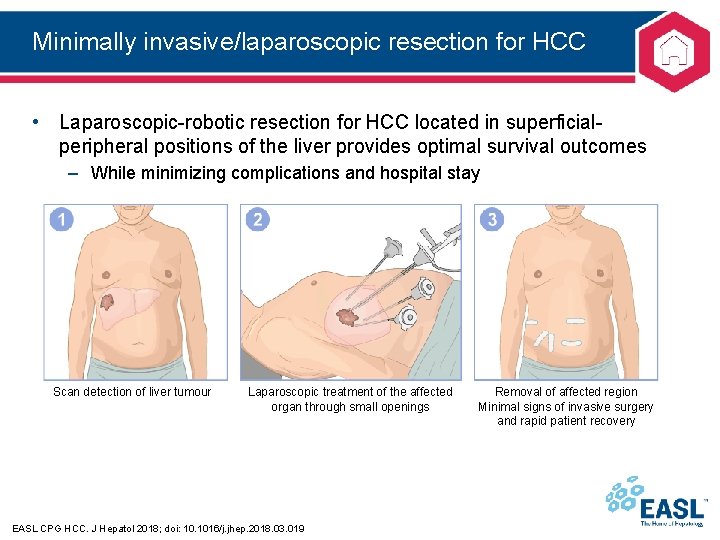 Minimally invasive/laparoscopic resection for HCC • Laparoscopic-robotic resection for HCC located in superficial- peripheral