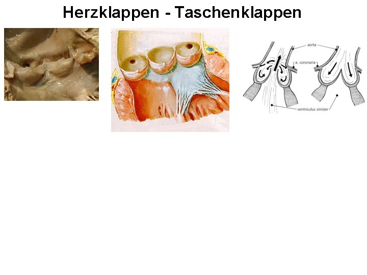 Herzklappen - Taschenklappen 