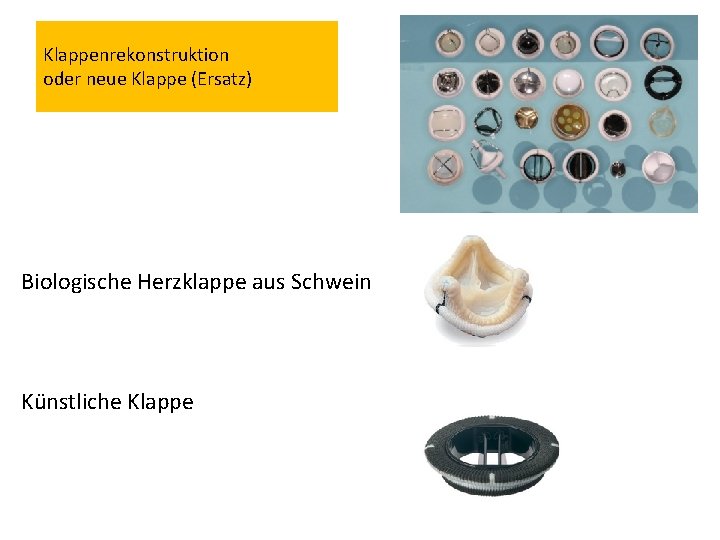 Klappenrekonstruktion oder neue Klappe (Ersatz) Biologische Herzklappe aus Schwein Künstliche Klappe 