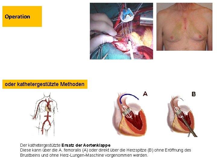 Operation oder kathetergestützte Methoden Der kathetergestützte Ersatz der Aortenklappe Diese kann über die A.