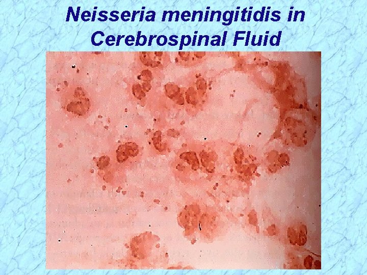 Neisseria meningitidis in Cerebrospinal Fluid 